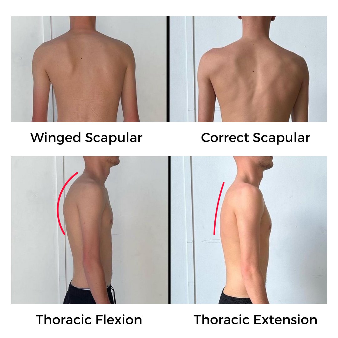 10 Effective Remedies for Your Aching Scapula: Why Your Shoulder Blade Pain Isn’t a Shoulder Problem