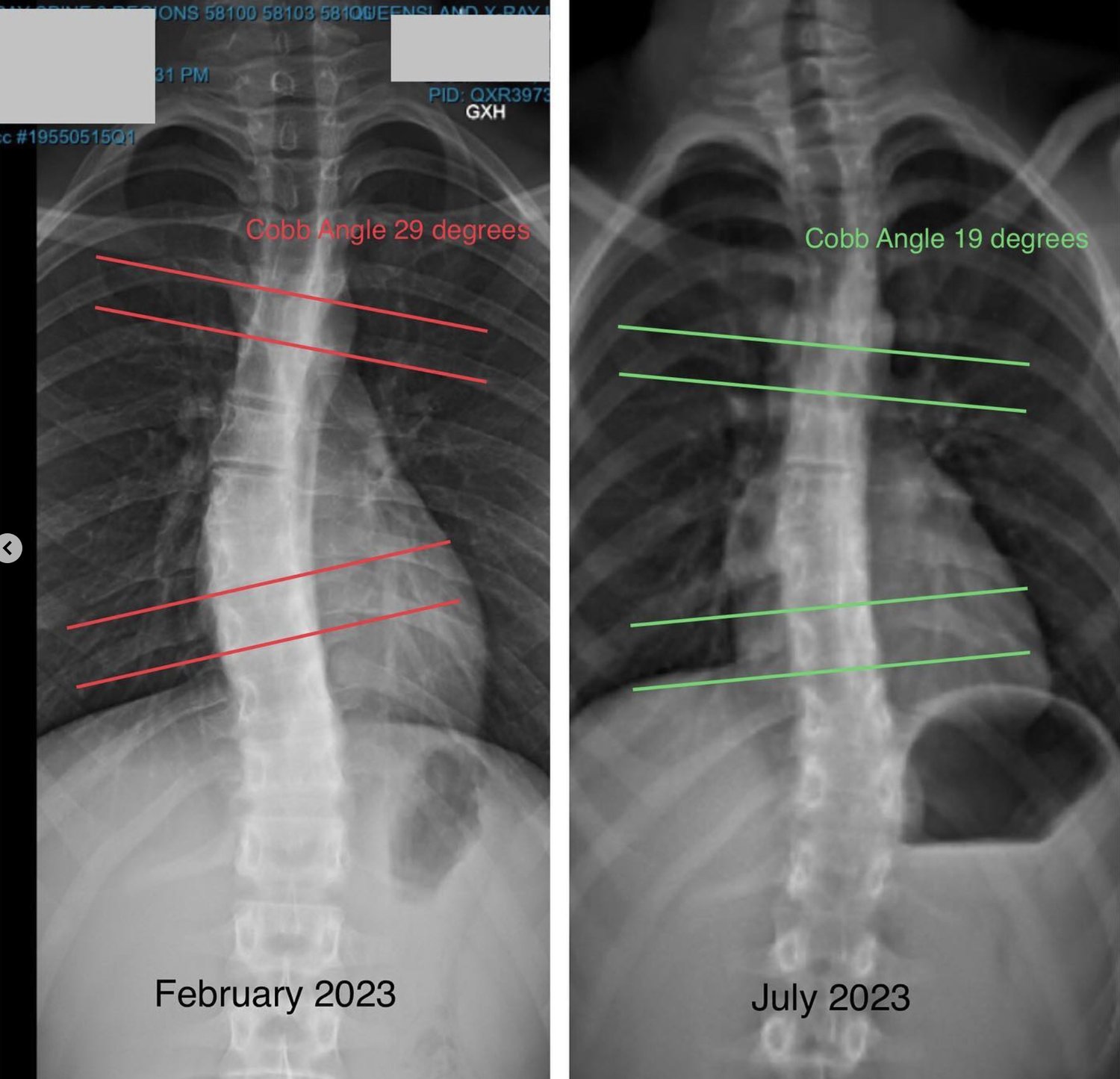 Why Functional Patterns is the Best Approach to Spinal Decompression