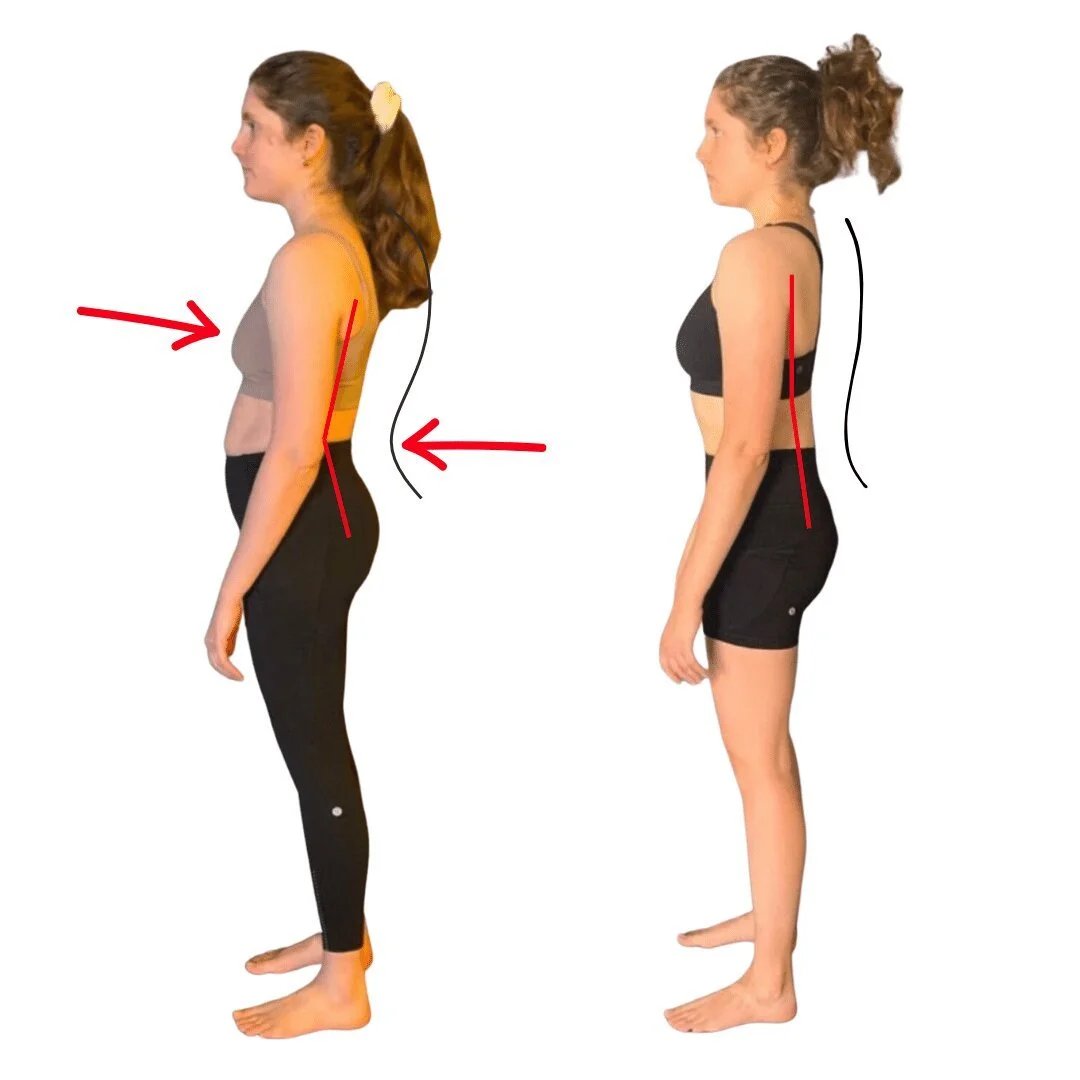 does poor posture matter