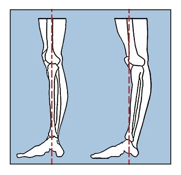 Exercises For Hyperextended Knees: A Guide To Strength