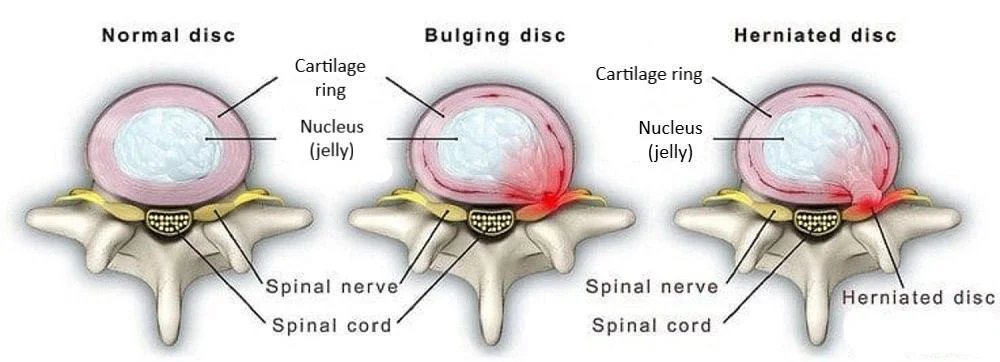 Bulging vs herniated disc — How to Heal a Bulging Disc Naturally — Functional Patterns Brisbane