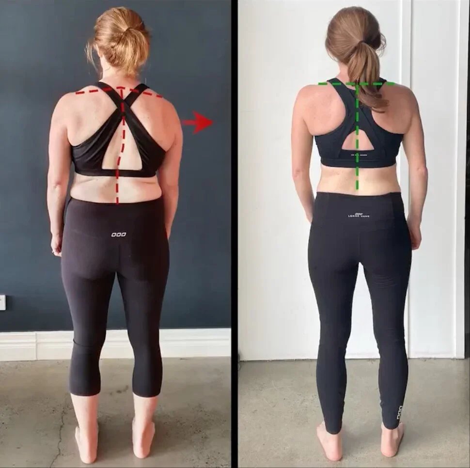 Can scoliosis be cured 1 — Is Scoliosis Hereditary? What Genetics Can — and Can’t — Explain