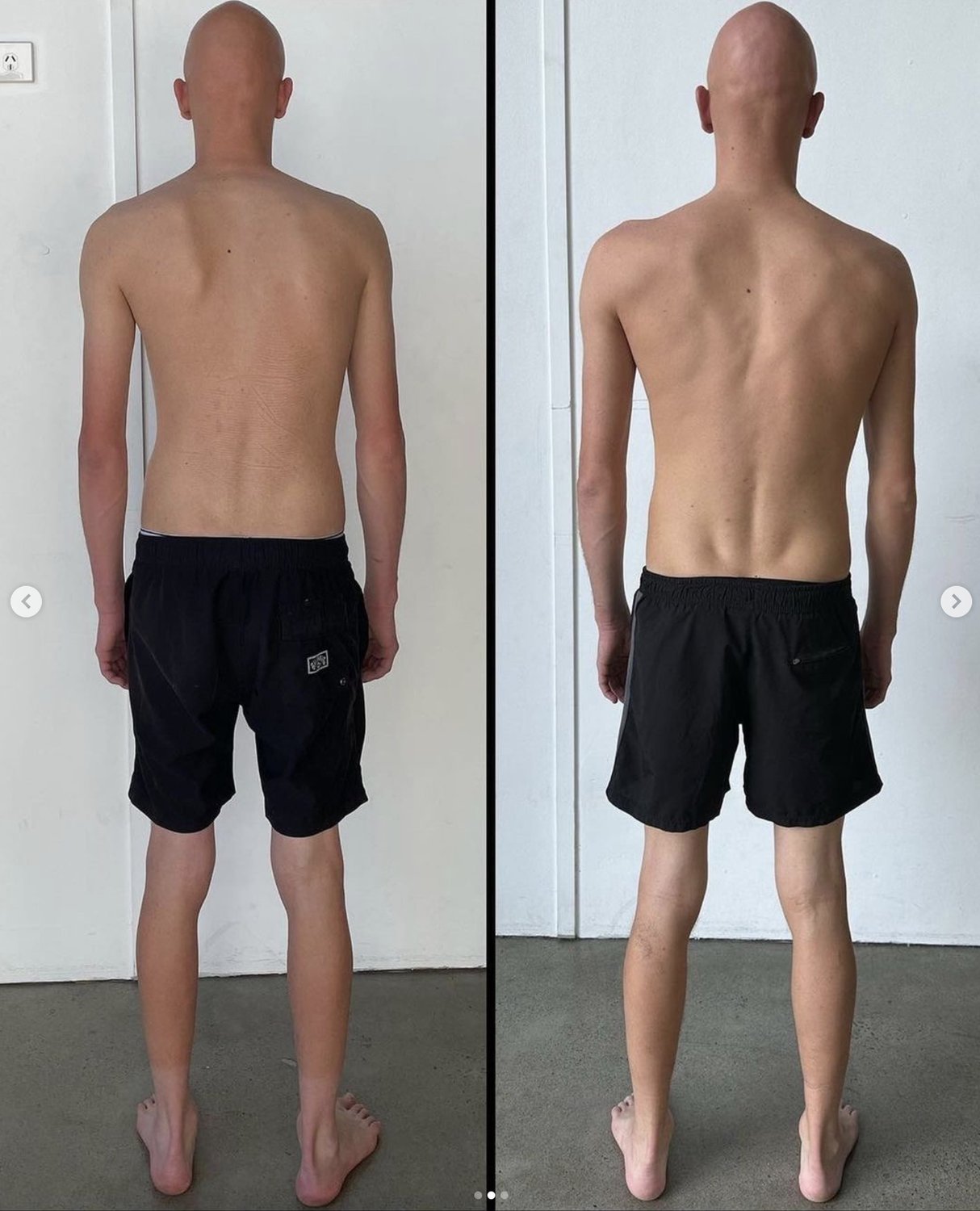Reversing Scoliosis Naturally: A Step-by-Step Case Study & Guide