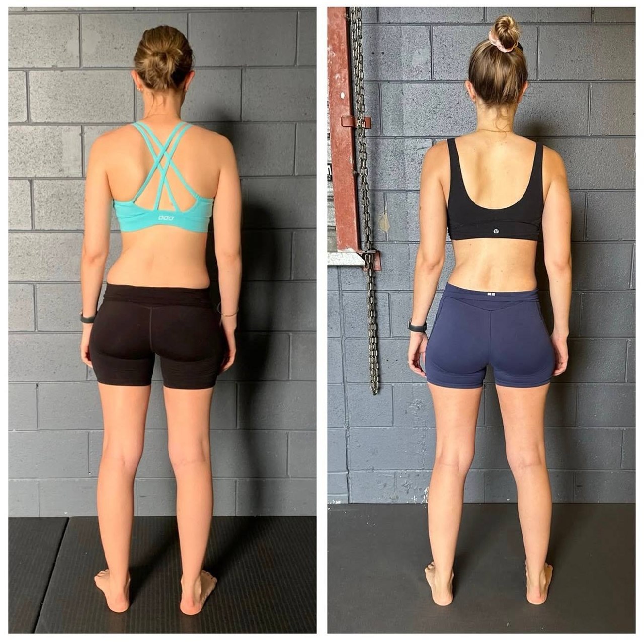 SCAPULAR WINGING: WHY EXERCISES ALONE WON’T FIX IT (AND WHAT WILL)