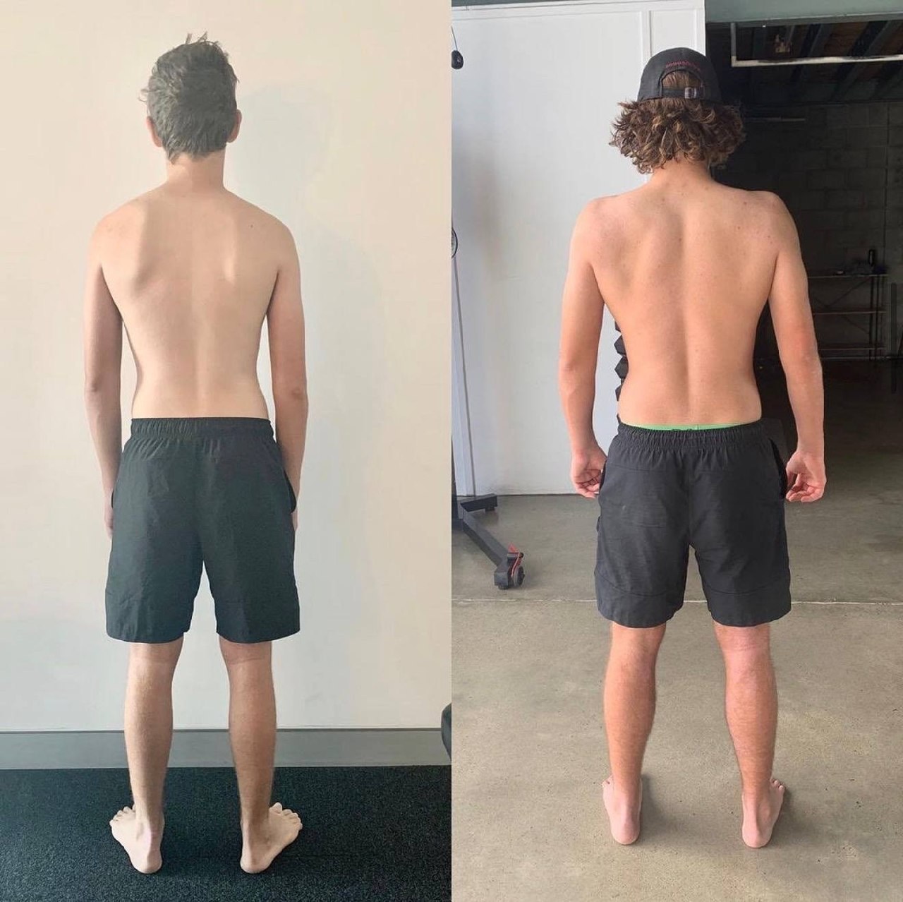 SCAPULAR WINGING: WHY EXERCISES ALONE WON’T FIX IT (AND WHAT WILL) — image 2