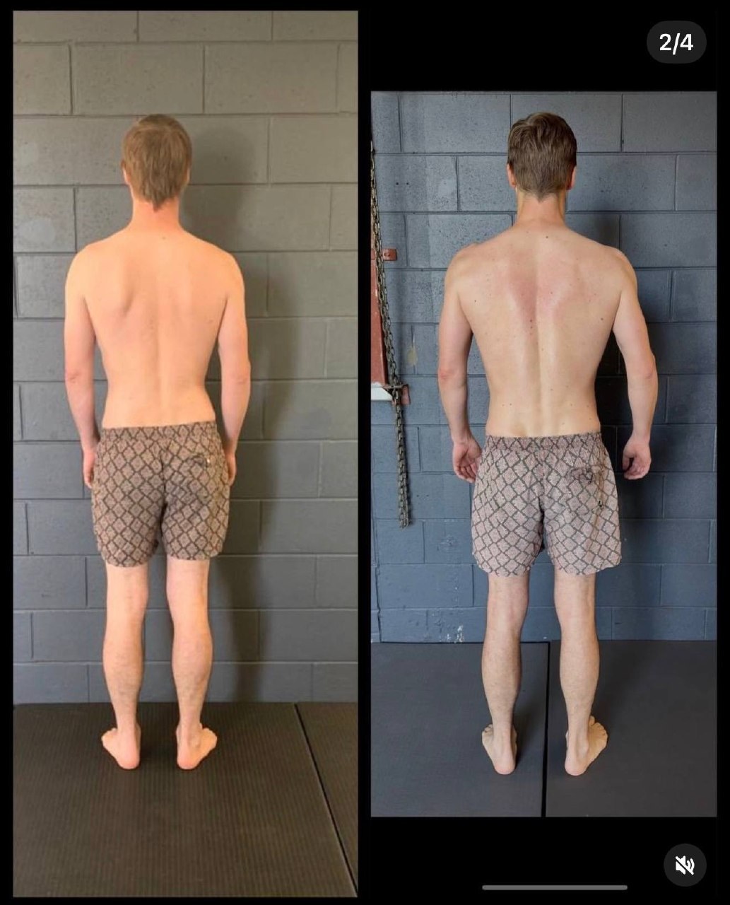 SCAPULAR WINGING: WHY EXERCISES ALONE WON’T FIX IT (AND WHAT WILL) — image 5
