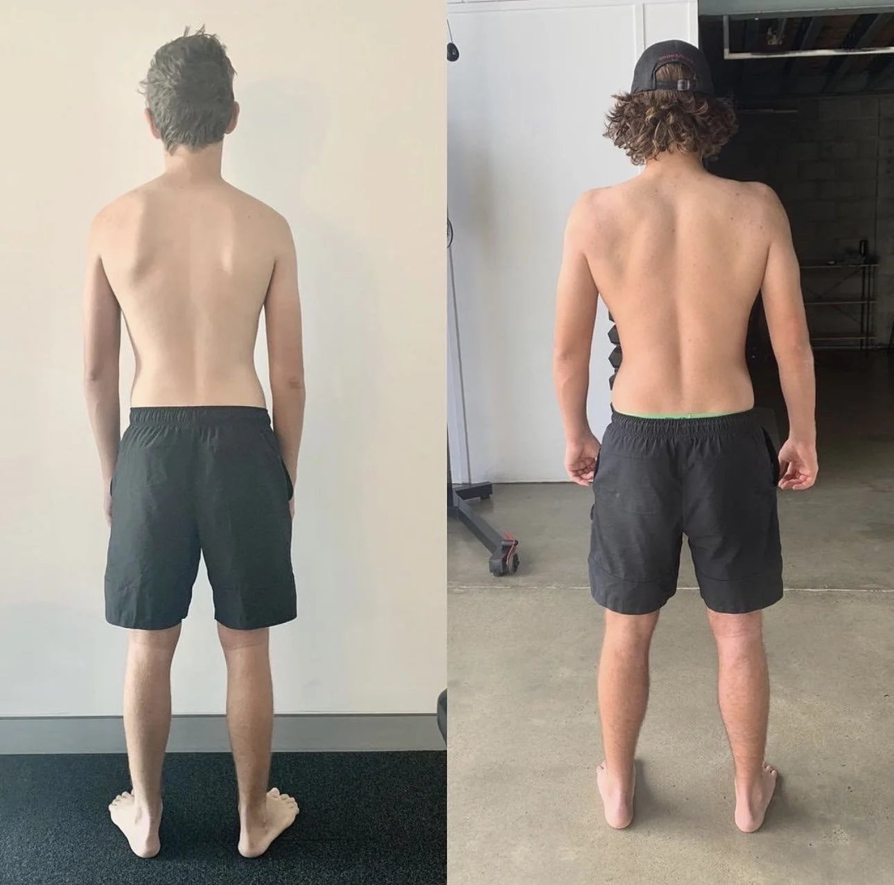 Thoracic Outlet Decompression - Surgery Vs Functional Movement 