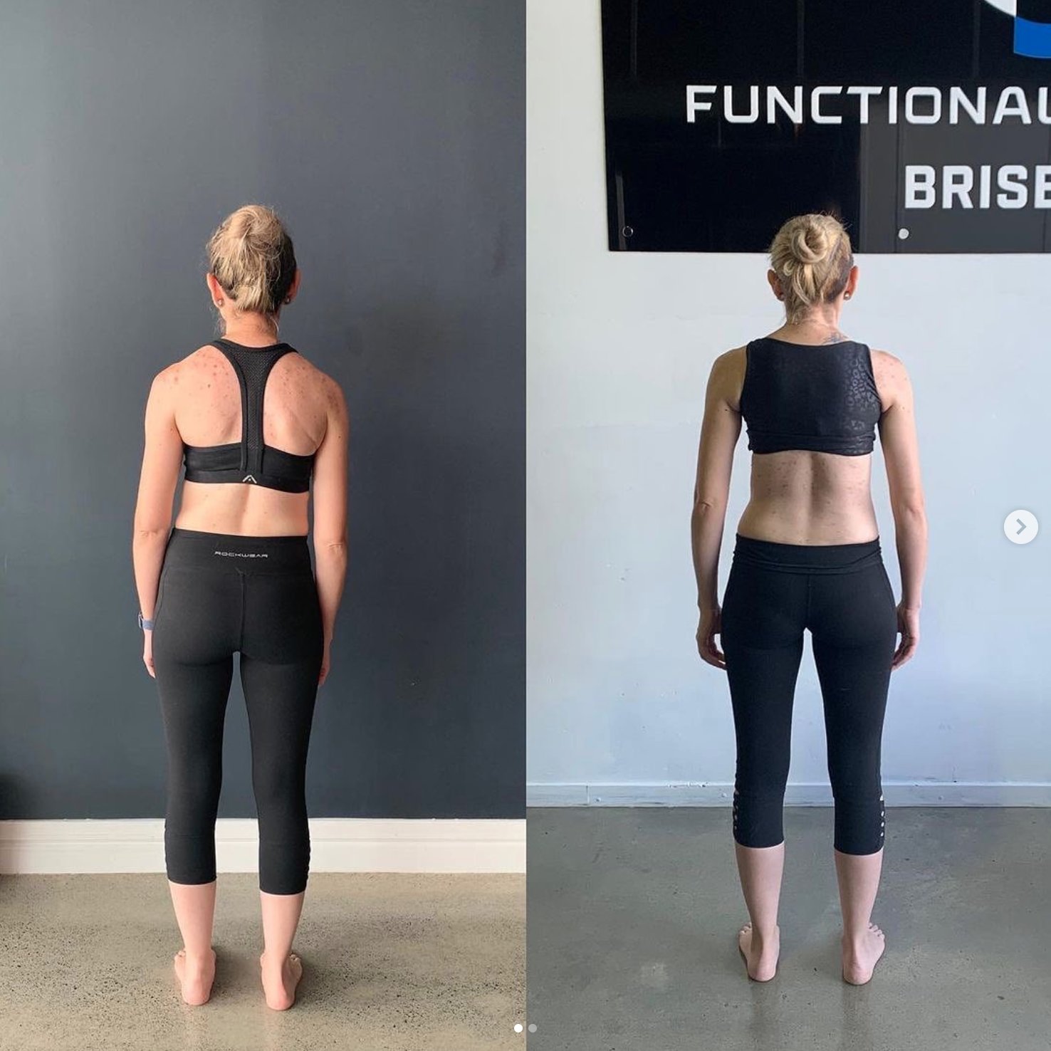 Unlocking Balanced Movement: A Holistic Approach to Understanding and Addressing Scoliosis