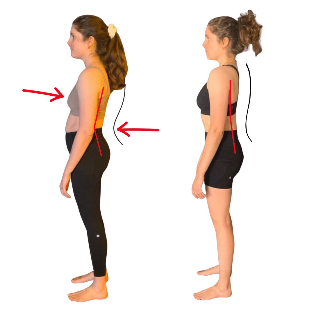 kypholordosis posture corrected naturally