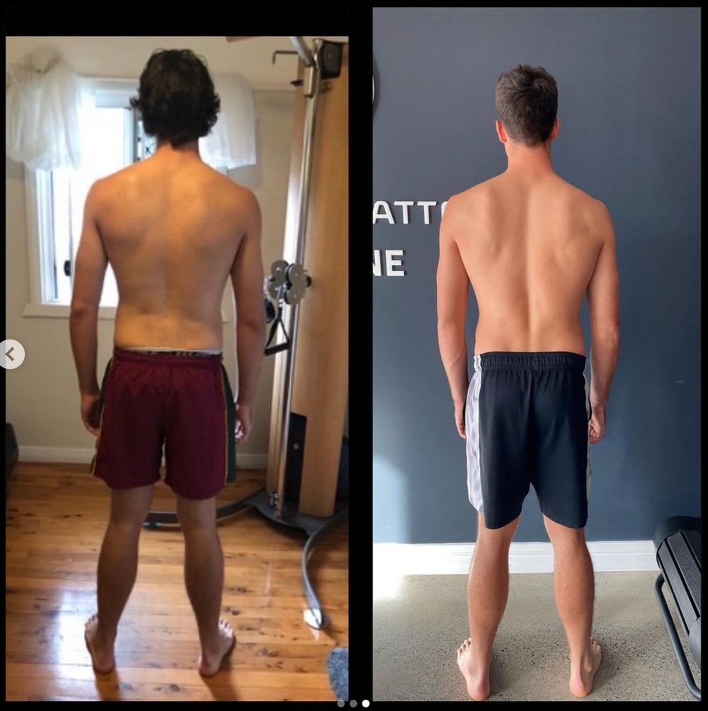 2 years chronic groin and lumbar pain reversed — Functional Patterns Brisbane