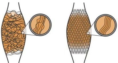 tight fascia and chronic pain — Functional Patterns Brisbane