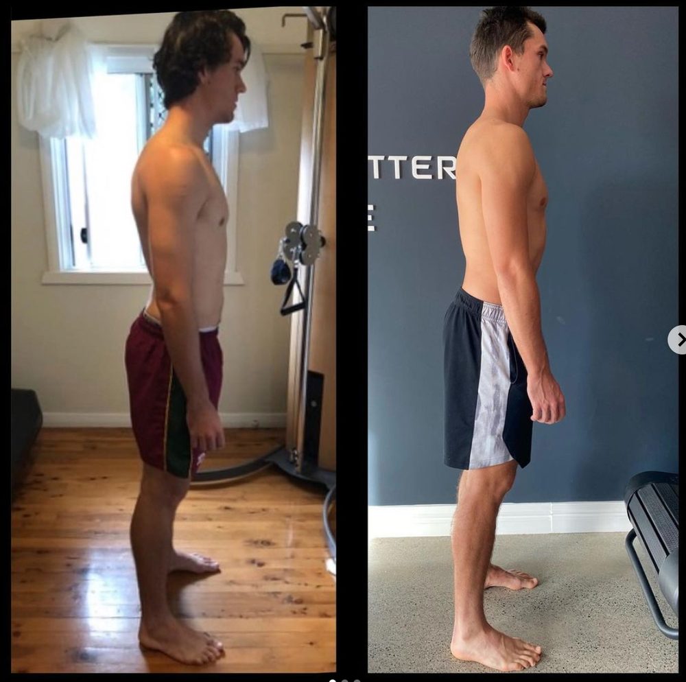 What Causes Bad Posture? — Functional Patterns Brisbane