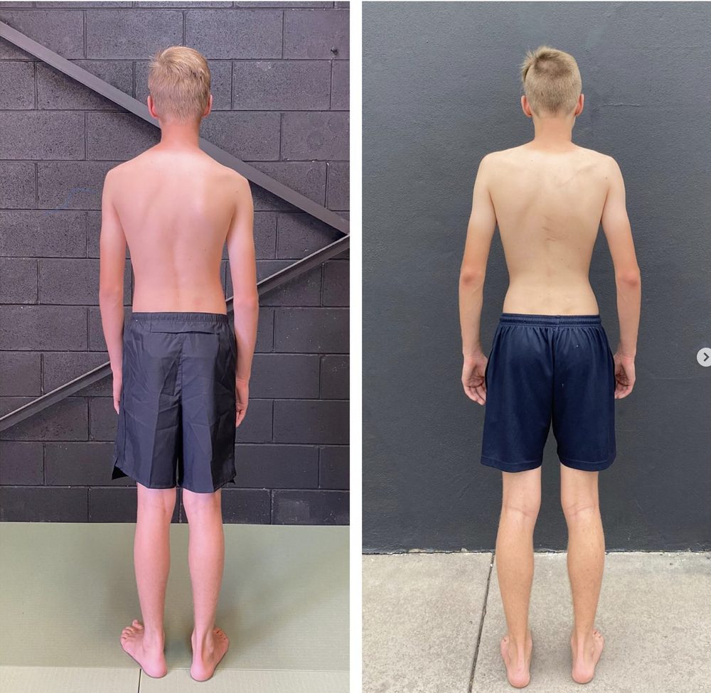scoliosis clinic brisbane — Functional Patterns Brisbane