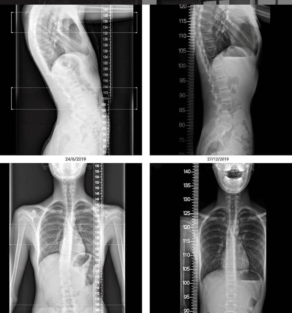 sideways curvature of the spine — Functional Patterns Brisbane