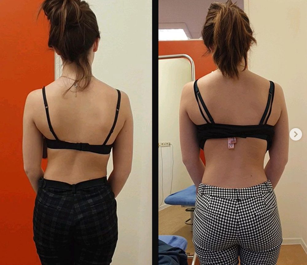 Some Scoliosis Before And Afters From Functional Patterns... — Functional Patterns Brisbane