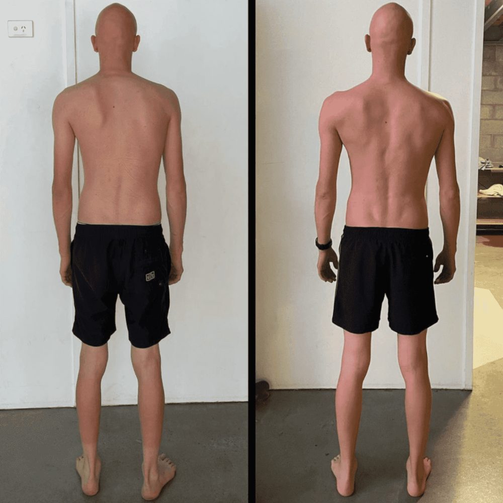 scoliosis correction brisbane — Functional Patterns Brisbane