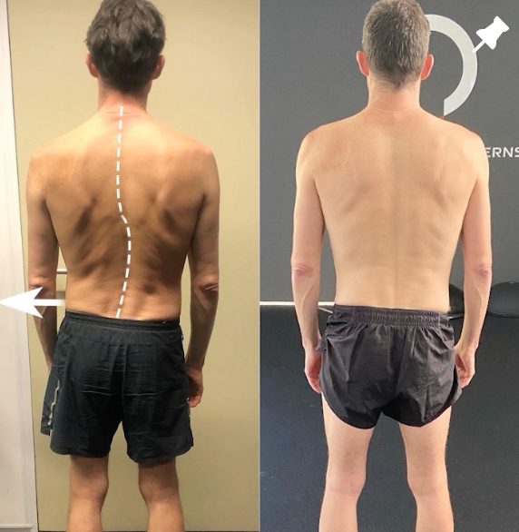 Straighten Scoliosis Naturally — Functional Patterns Brisbane