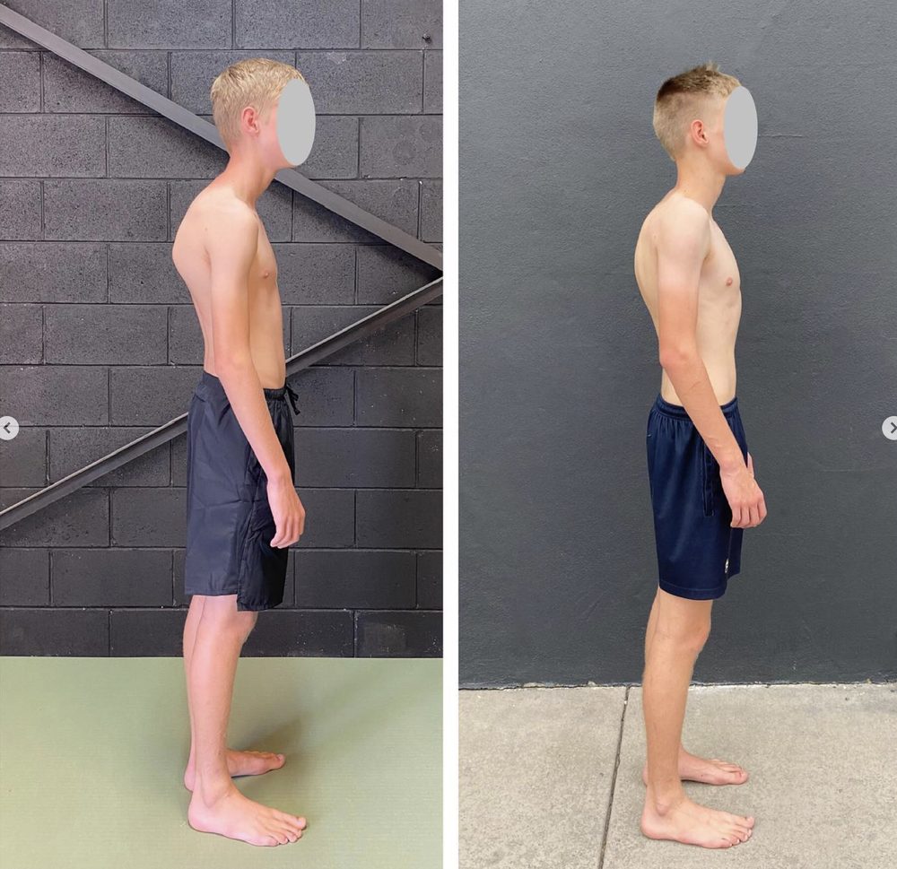 can scoliosis be corrected — Functional Patterns Brisbane