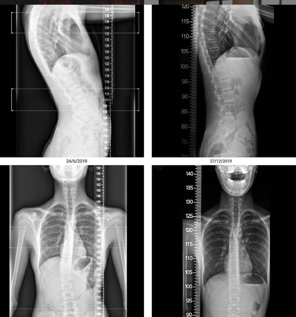 More Straightened Spines & Changed Lives — Functional Patterns Brisbane