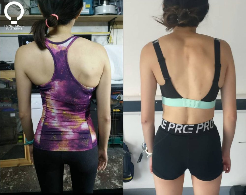 More Straightened Spines & Changed Lives — Functional Patterns Brisbane