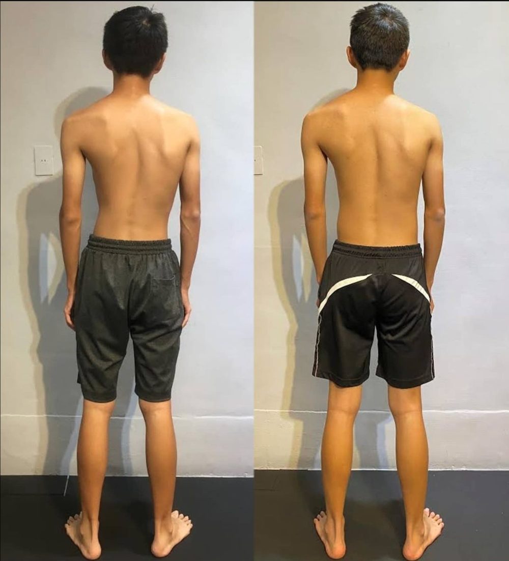 More Straightened Spines & Changed Lives — Functional Patterns Brisbane