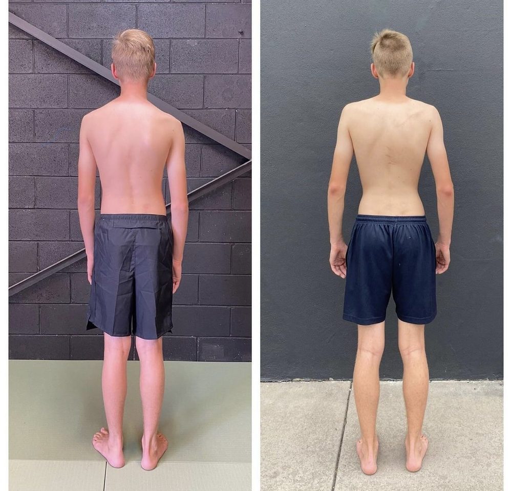 More Straightened Spines & Changed Lives — Functional Patterns Brisbane