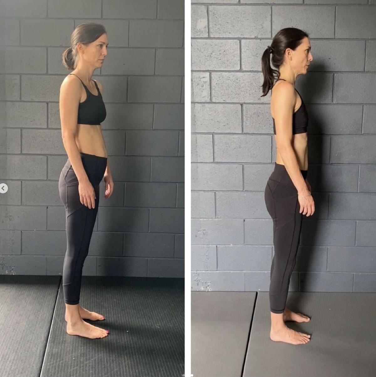 Natalie scoliosis and posture correction