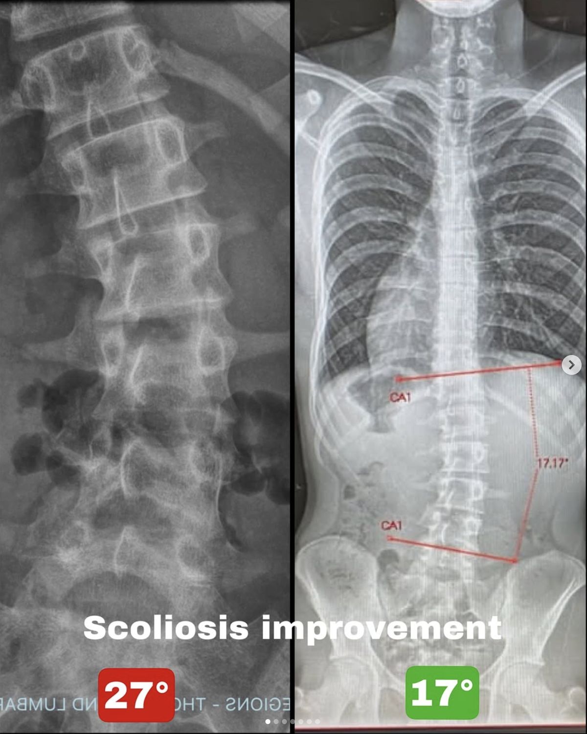 Scoliosis client return to boxing