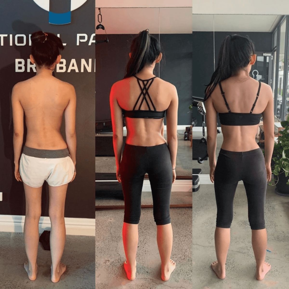 Melissa scoliosis correction results